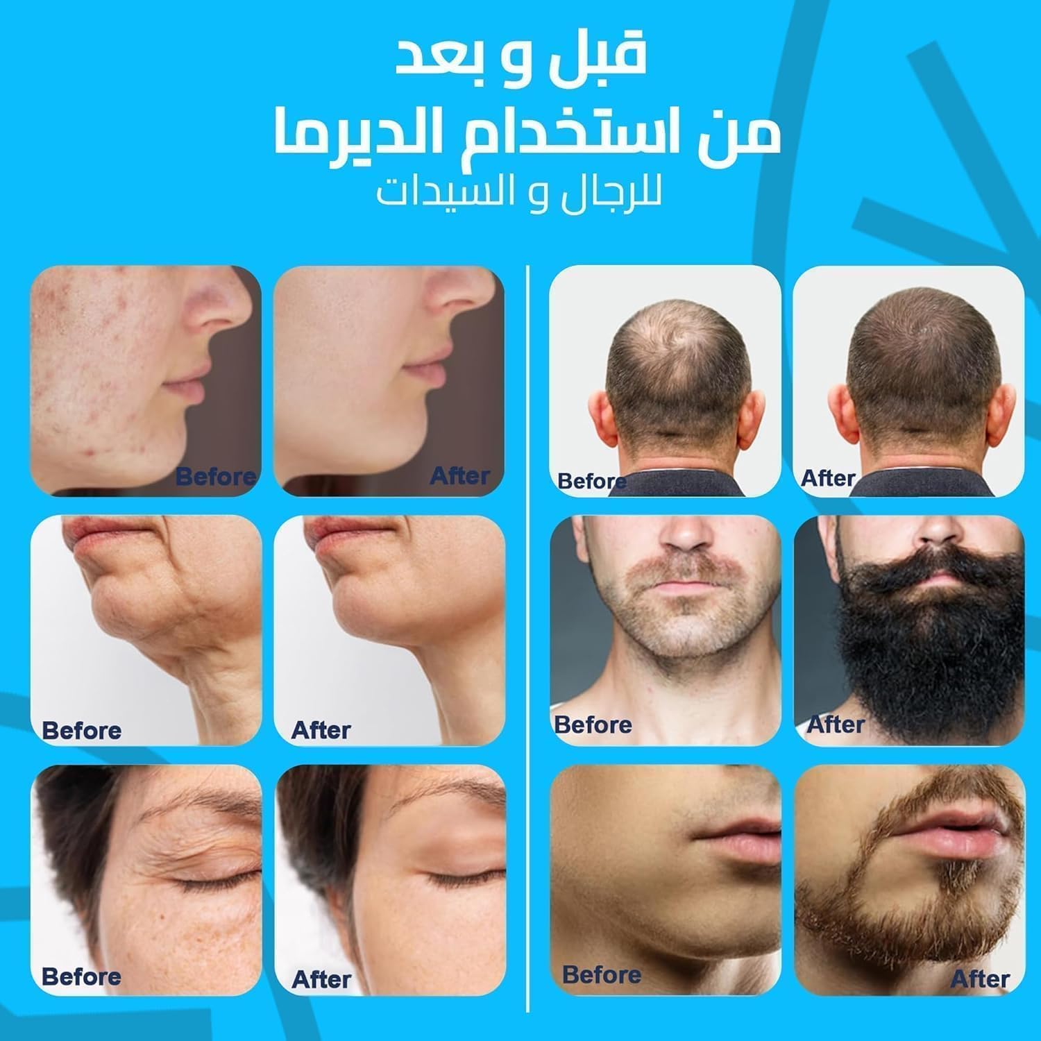 71NVaDOB-LL._AC_SL1500_ أداة ديرما رولر للوخز بالإبر الدقيقة مع 140 إبرة من التيتانيوم، قلم ديرما 0 ملم - 3 ملم لترميم بشرة الوجه ونمو الشعر واللحية آمن وفعال وسهل الاستخدام - الصورة 4